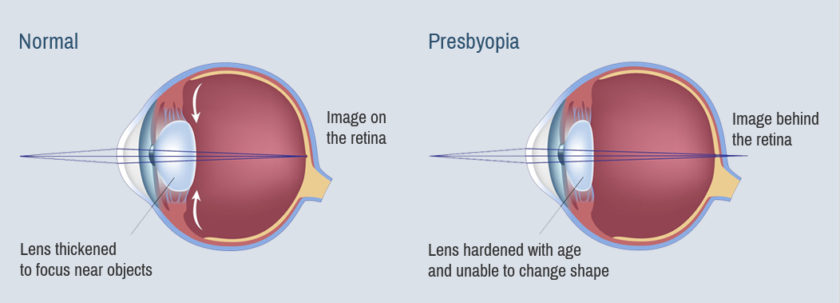 Do I have presbyopia ? What are my options