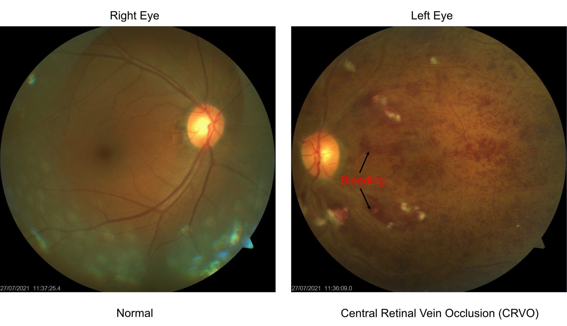 Eye Stroke