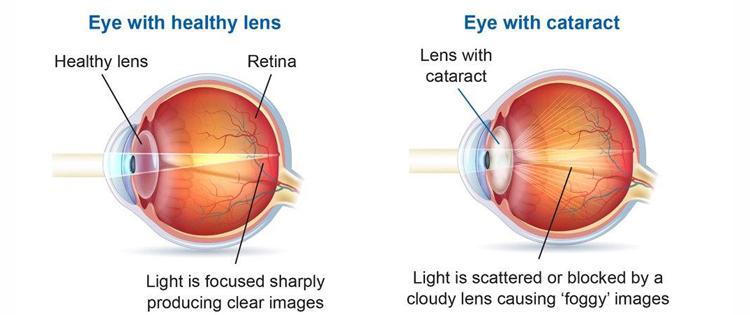 Healthy Eye VS Eye with Cataract