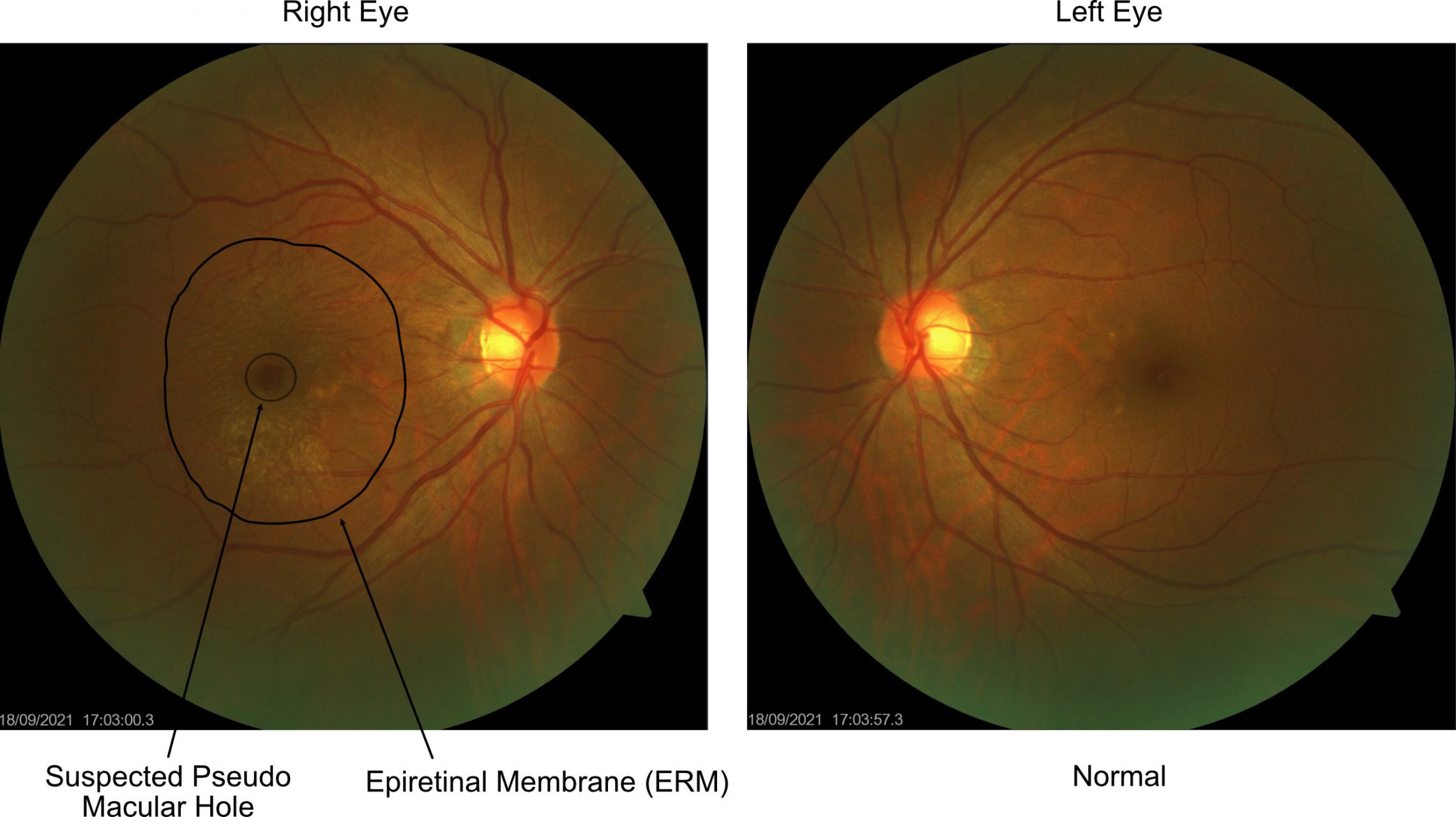 Eye Exam FP- ERM