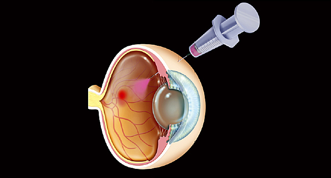 Eye Injections for Diabetic Retinopathy