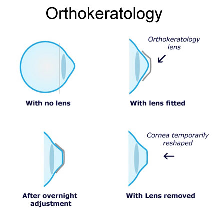 Ortho K