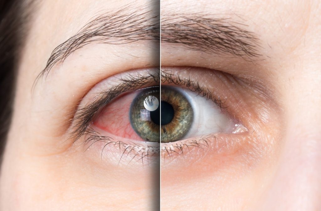 Red eye caused by dry eyes