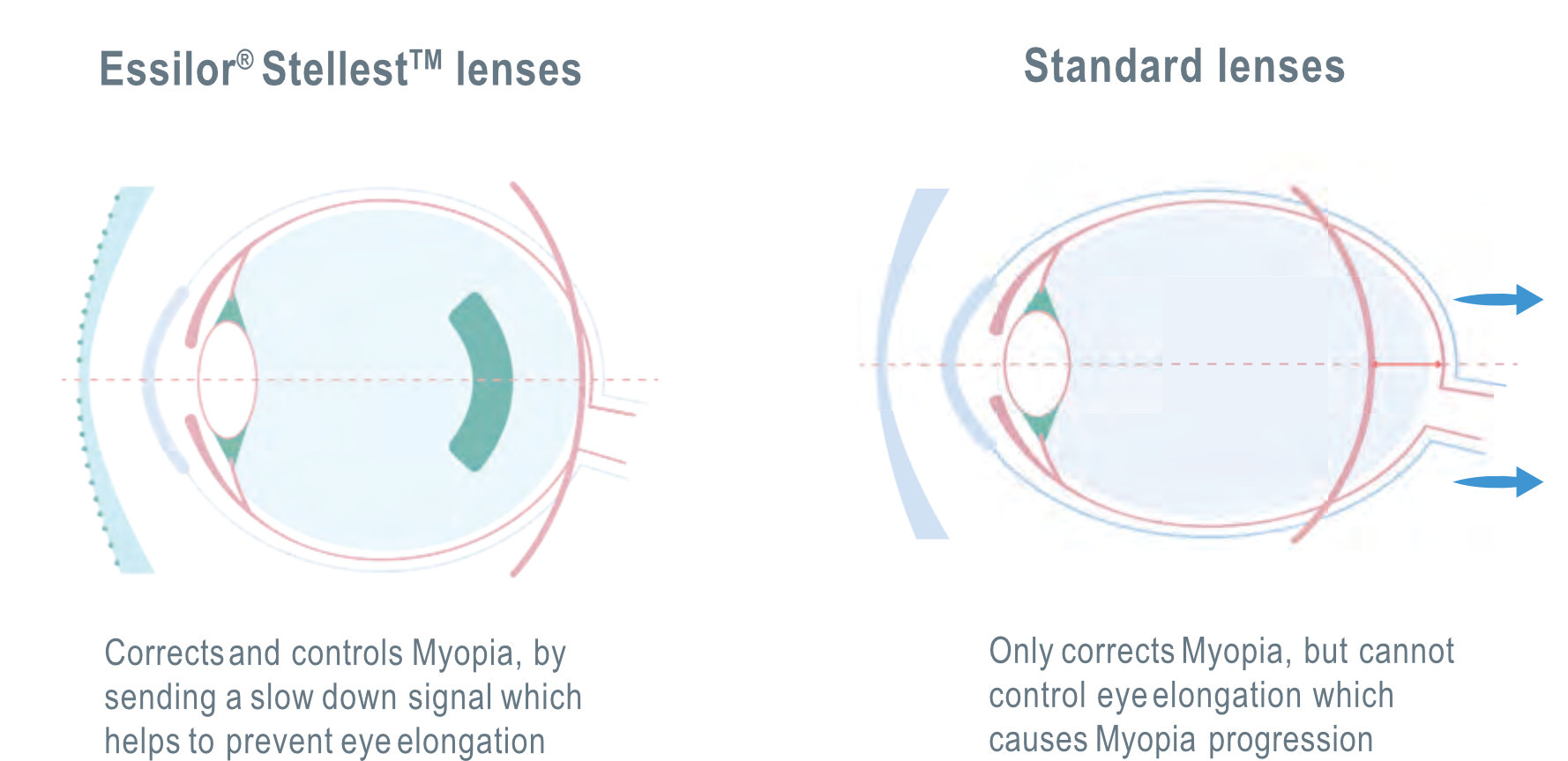Essilor Stellest VS Standard lens