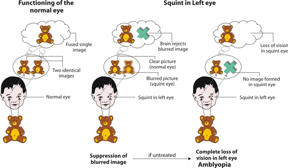 Strabismic Amblyopia