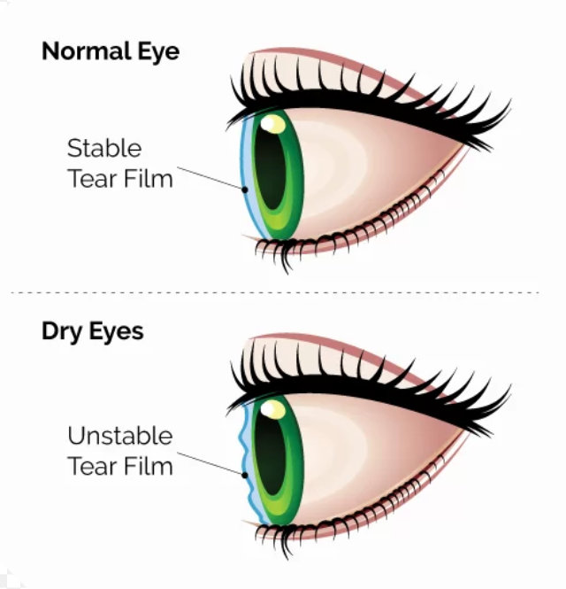 Unstable tear film due to dry eyes