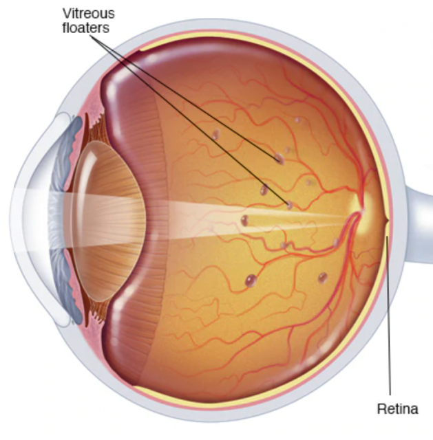 floaters after retina surgery