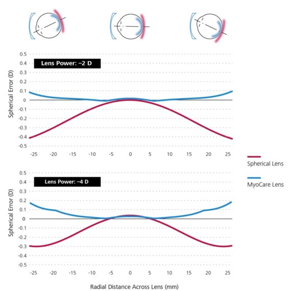 ZEISS MyoCare - New Myopia Control Lens - Evershine Optical